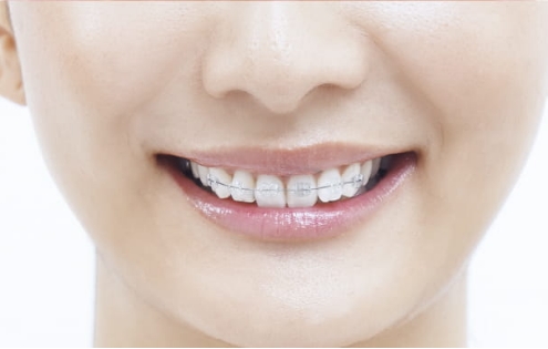 クリアブラケット