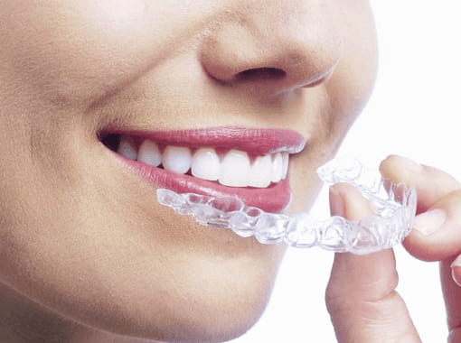 インビザライン