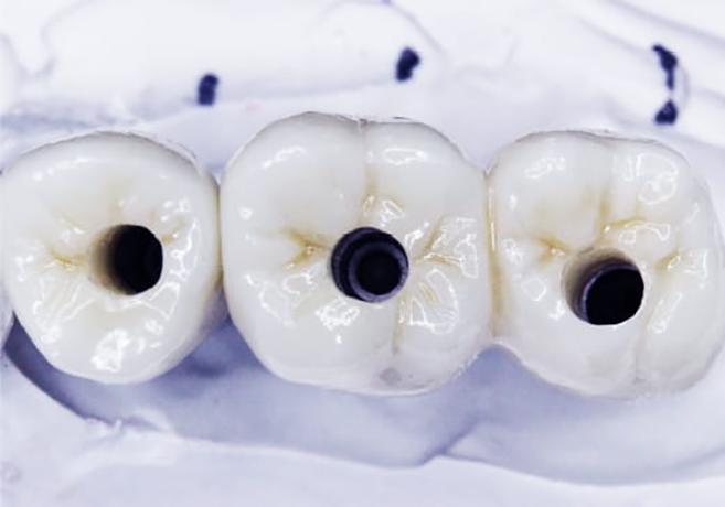 ストローマン社 インプラント体