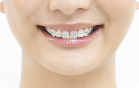 ブラケット矯正